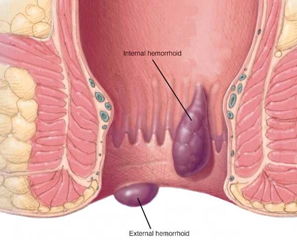 anus itching inside Deep