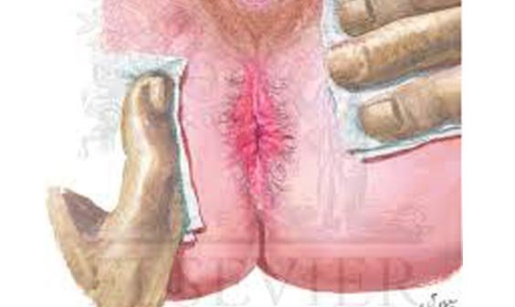 Perianal Dermatitis